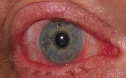 oGVHD eye