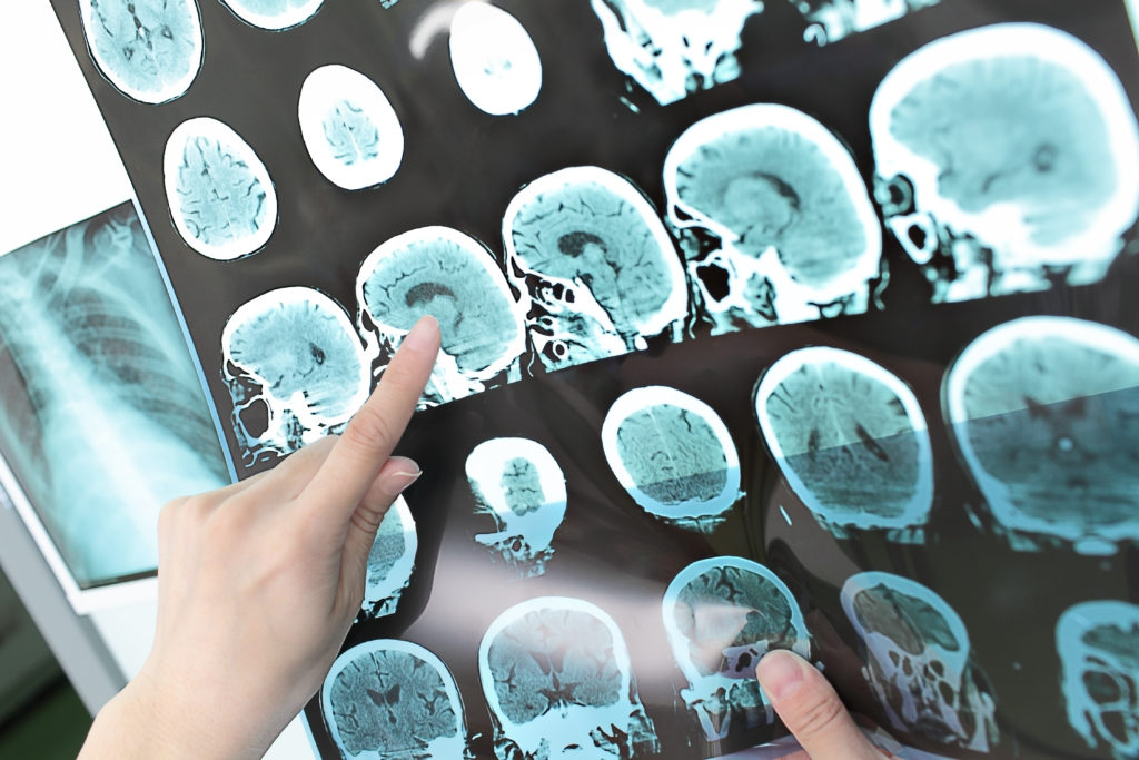 EBV causes MS