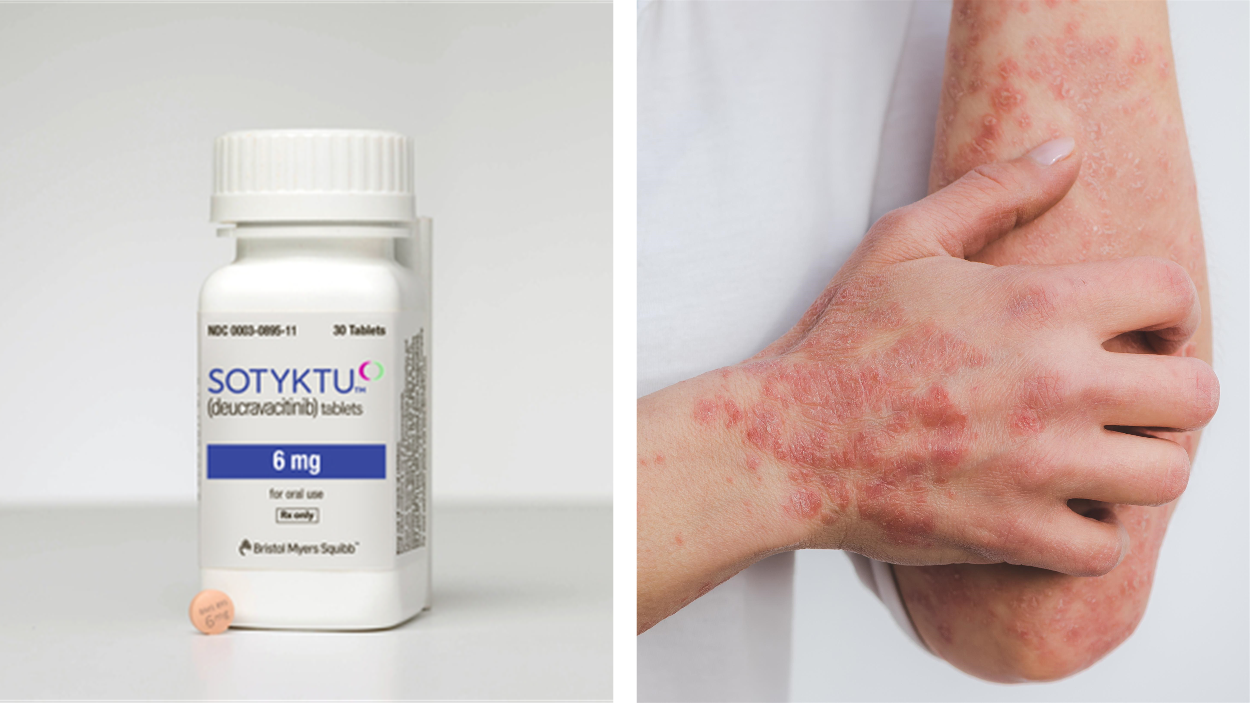 Sotyktu (deucravacitinib) Gets FDA Approval for Moderate-to-Severe Plaque Psoriasis