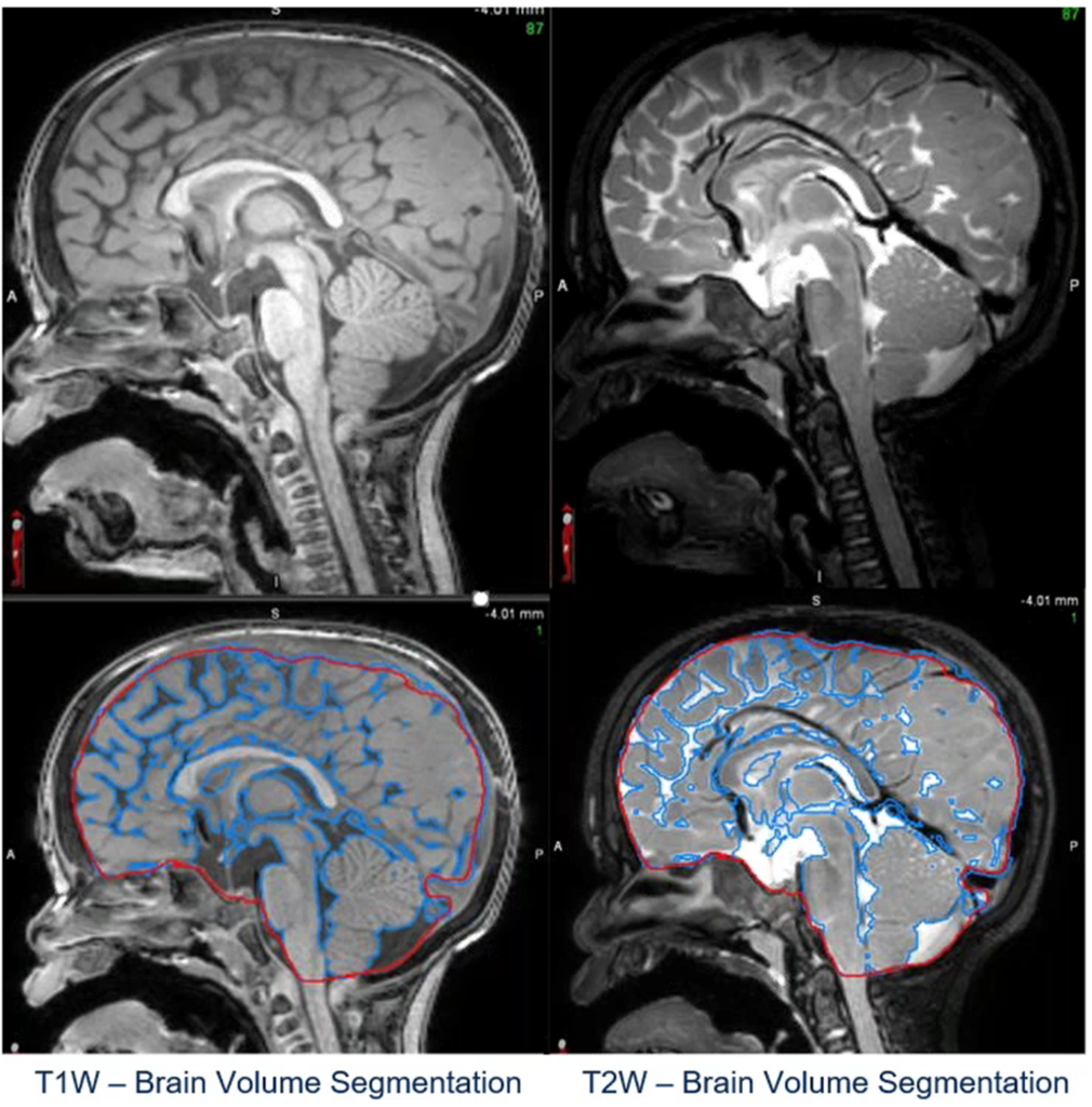 Navigating Neuroscience Trials: Biomarkers, Imaging and CRO Strategies ...