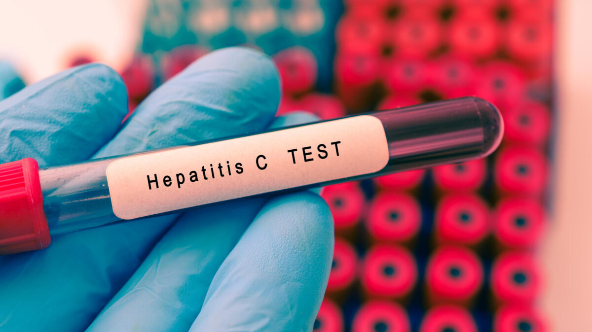 HCV Test, HCV, Hepatitis C Test, Hepatitis C, Hepatitis C Blood Test