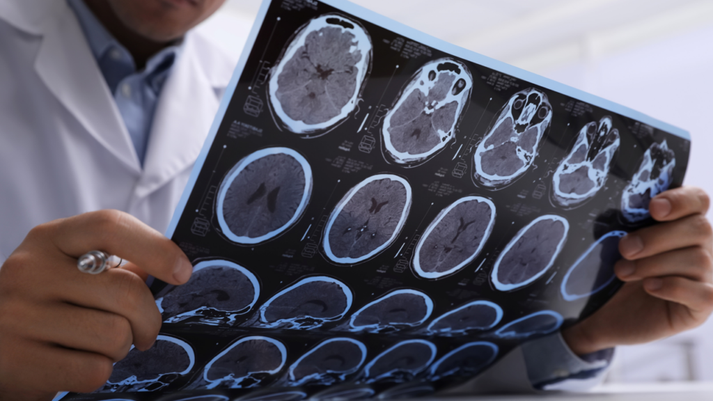 ALS, amyotrophic lateral sclerosis, ALS disease, Neurodegenerative Disease