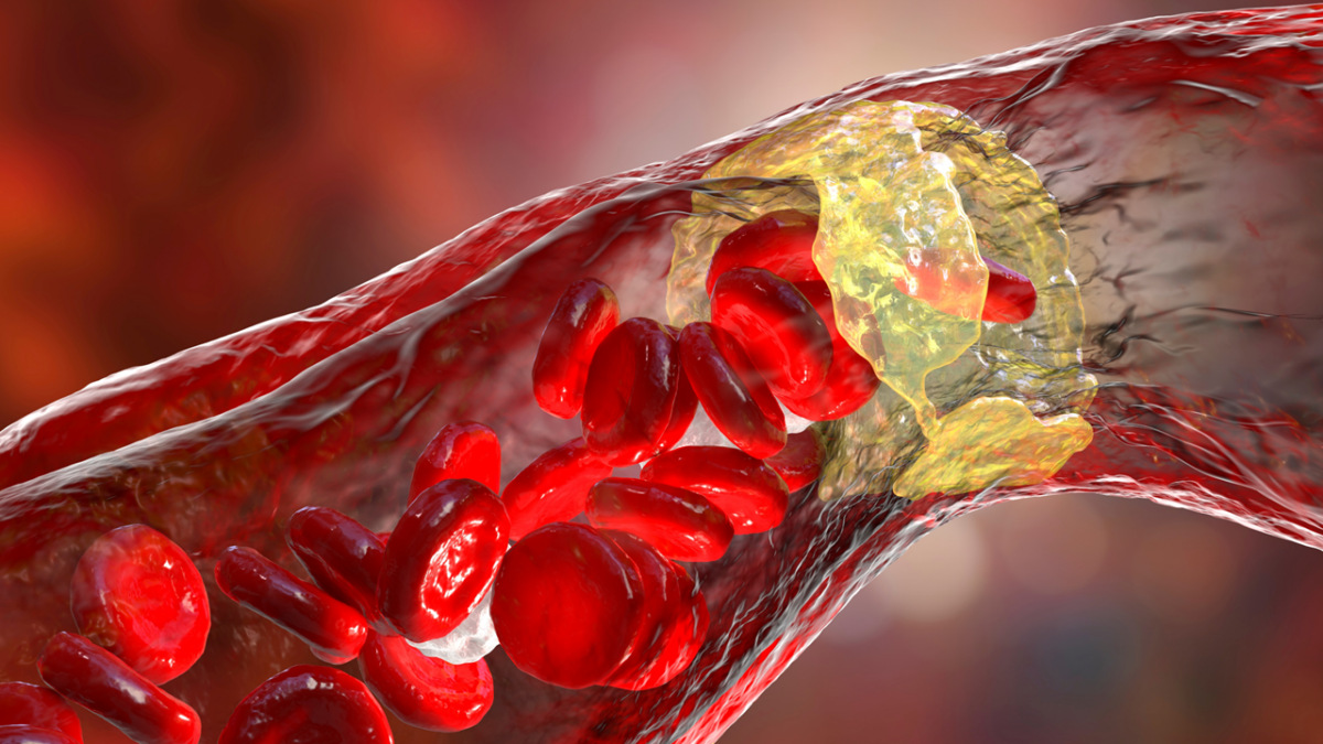 obicetrapib, Menarini, Hefh, cetp, ldl cholesterol, ezetimibe, Heterozygous familial hypercholesterolemia