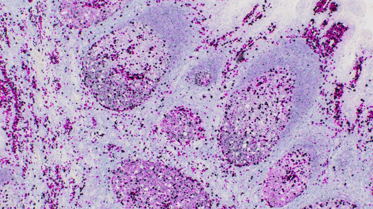 Ventana Assay, lymphoma diagnosis, non hodgkin's lymphoma diagnosis, B-cell lymphoma, Roche Diagnostics, Roche