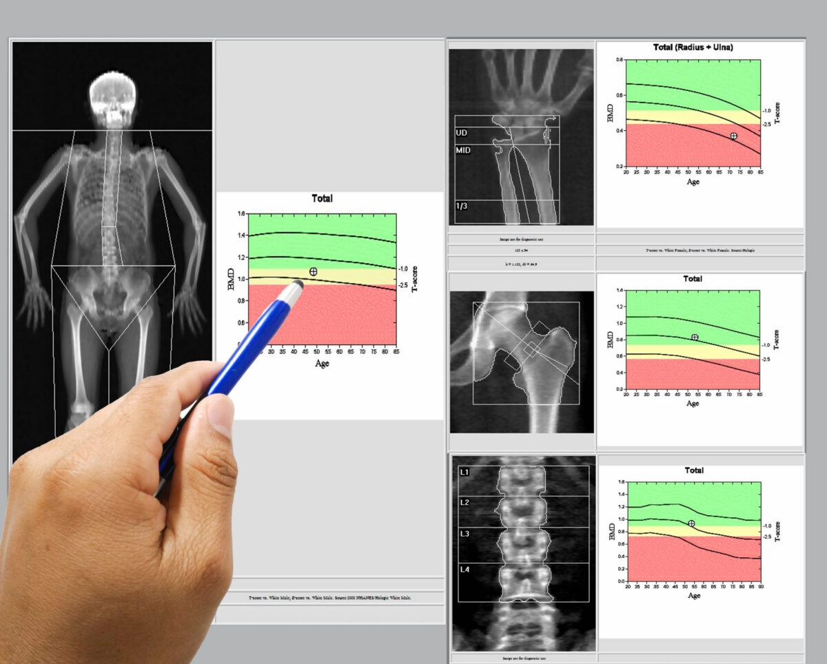 Osteoporosis Clinical Trials